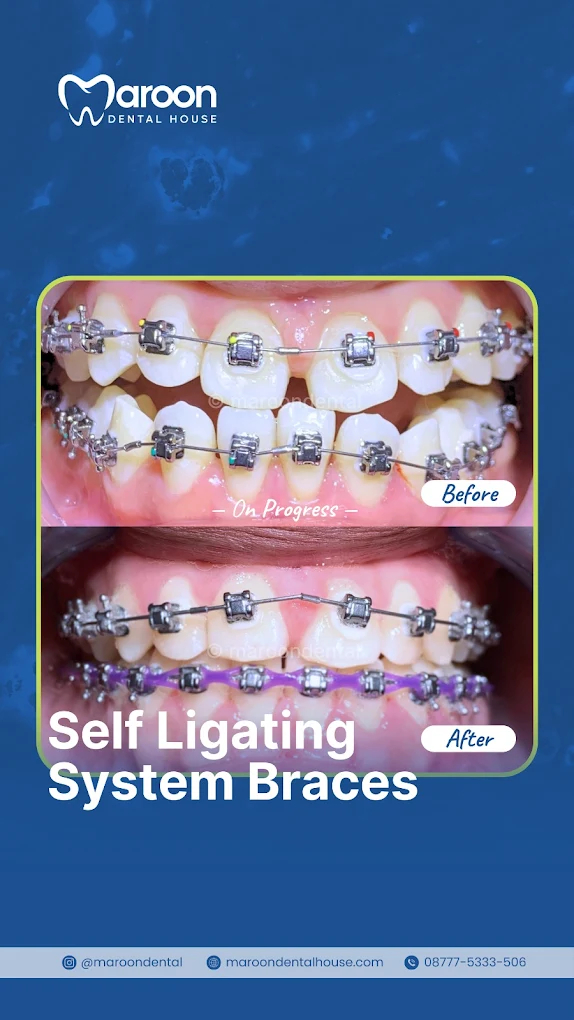 Hasil pemasangan behel self ligating di Maroon Dental House