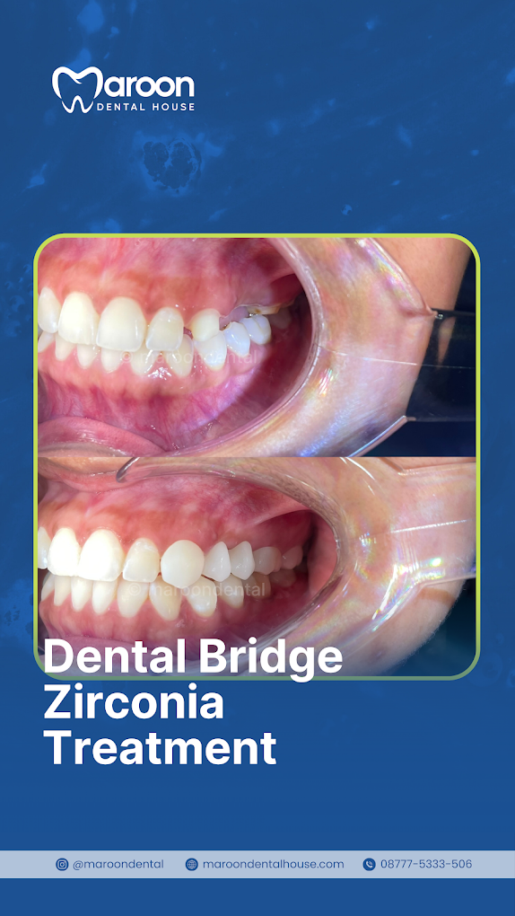 Hasil perawatan dental bridge zirconia di Maroon Dental House Depok