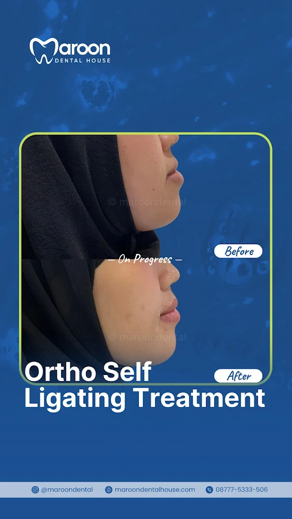 Hasil perawatan ortodonti self ligating di Maroon Dental House