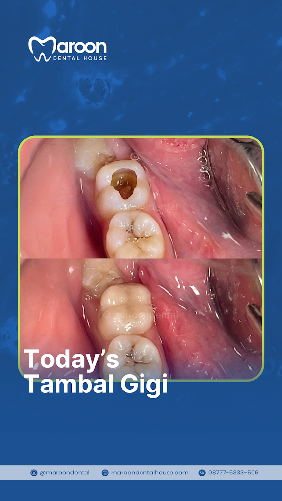Hasil tambal gigi sebelum dan sesudah di Maroon Dental House - Tambalan composite sewarna gigi